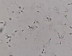 A microscopic view showing numerous human sperm cells swimming in various directions, illustrating sperm motility and movement.